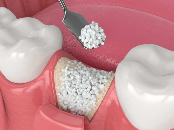 Ghép xương khi trồng implant