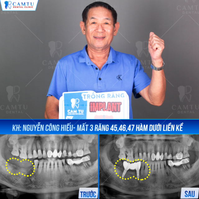 Trồng răng Implant ở đâu tốt - Nha khoa Cẩm Tú địa chỉ uy tín số 1
