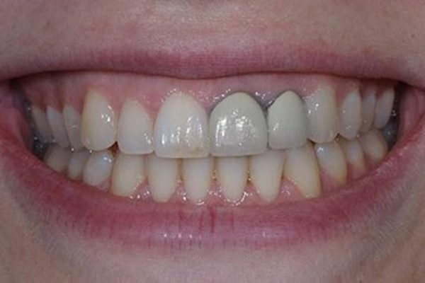 Bọc sứ titan có bị đen viền nướu không?