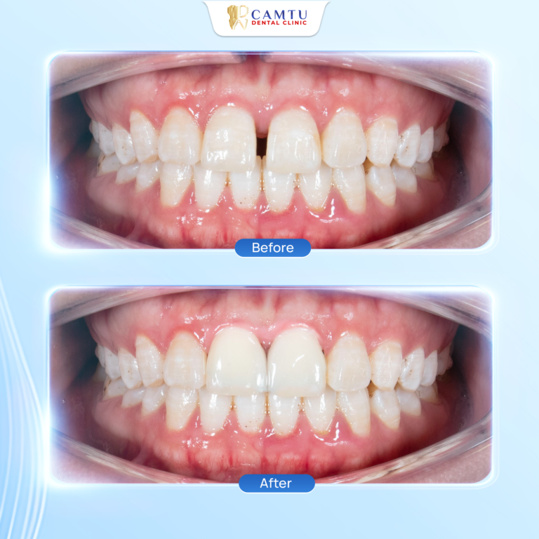 Tại sao ngày càng nhiều người lựa chọn bọc răng sứ?